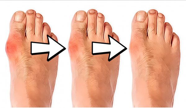 Natural Way to Get Rid Of Bunion