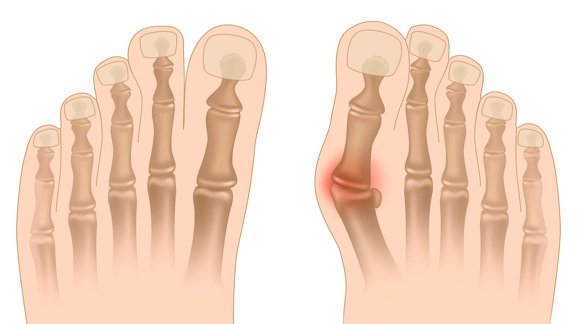 What to do when you have a bunion