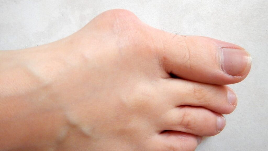 Bunion on a foot — big toe drifting toward the smaller toes