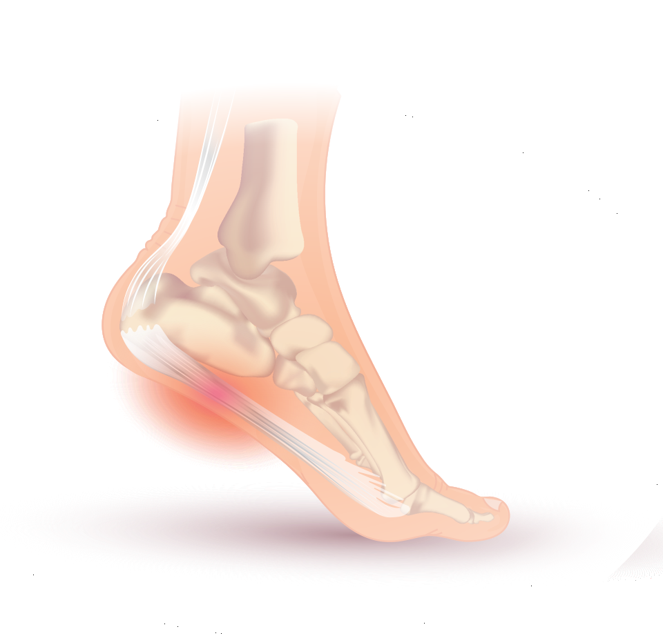 Diagram of the foot showing the plantar fascia and heel pain point